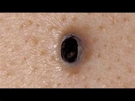 One of the most pleasing and enjoyable big blackheads popping videos ever. . Biggest squeezed blackhead